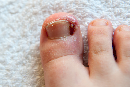 Does Ingrown Toenail Surgery Hurt? - Your Foot Clinic